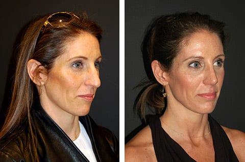 best open rhinoplasty nyc