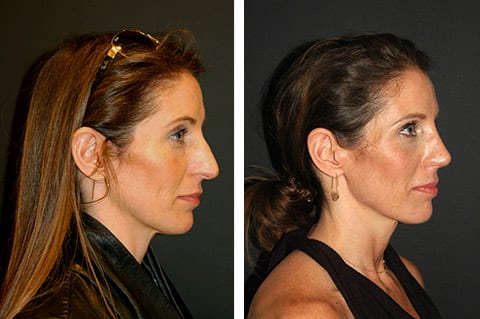 open rhinoplasty before and after nyc