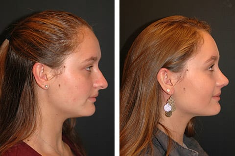 best closed rhinoplasty results
