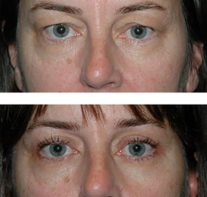 best eye lid surgery nyc