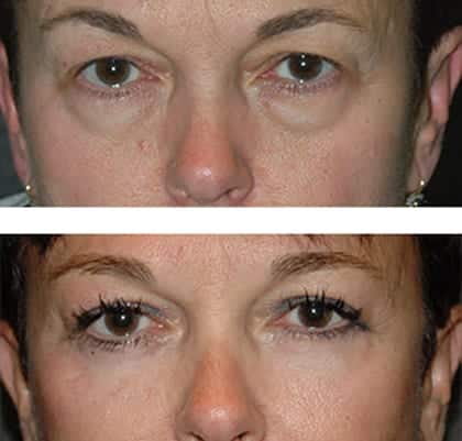 best eyelid before after