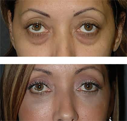 best eyelid lift nyc