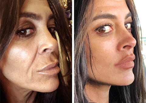 best lip lift facelift surgeon