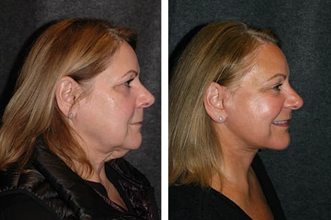 best lower facelift before and after