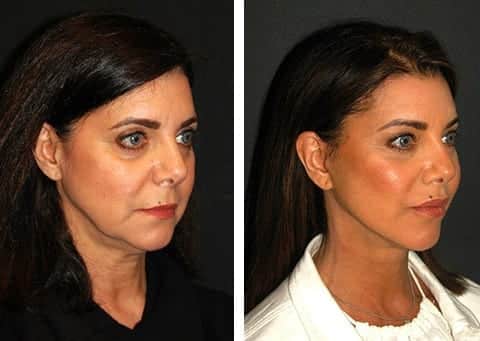 best new york facelift surgeon
