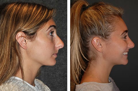 closed rhinoplasty before after
