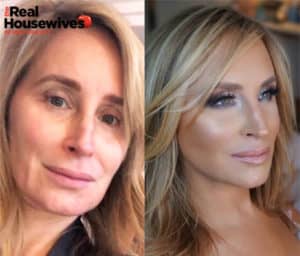 Sonja Morgans Facelift