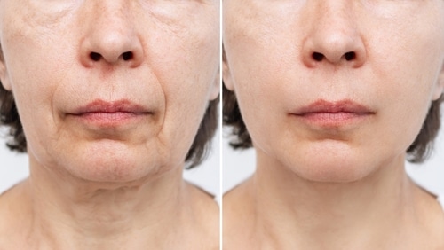 Before and after pictures of a woman with a facelift