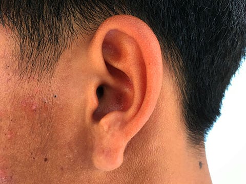earlobe reduction surgery new york