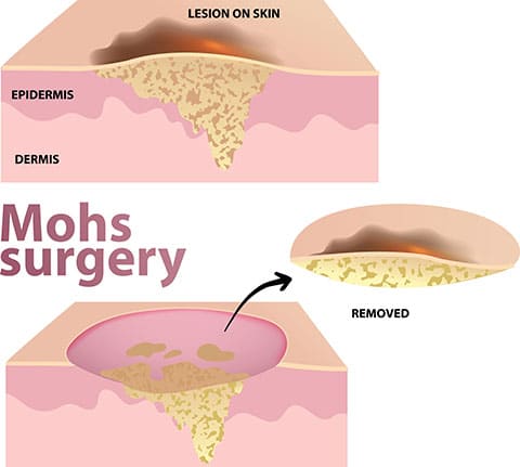 Mohs Surgery Illustration