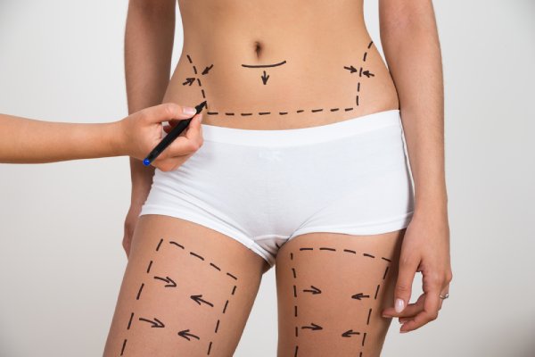 A woman being marked for cosmetic surgery