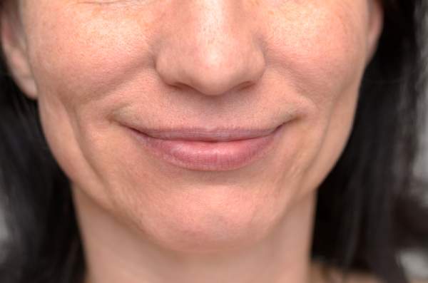 A woman’s mouth and chin showing smile lines