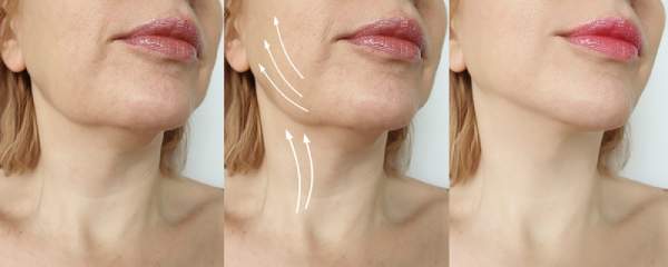 The before and after pictures of a woman getting a neck lift