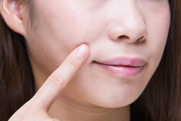 A woman points to where smile lines would be