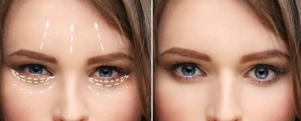A woman around 30 getting a facelift