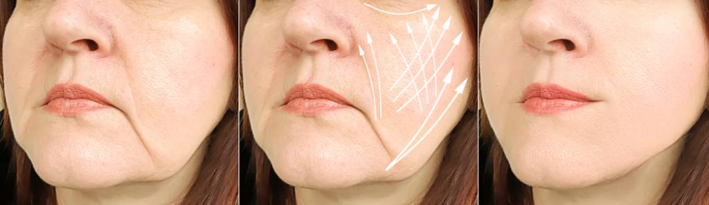 Facelift before and after images