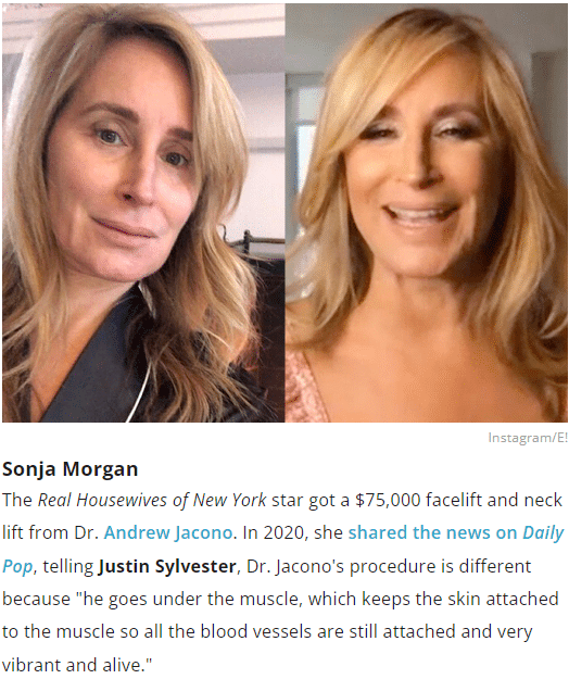 Sonja Morgan Facelift Before and After os seen on EOnline!