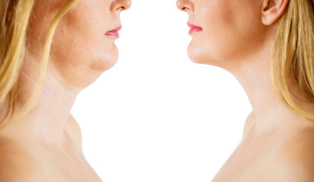 A before and after image of someone who has undergone double chin surgery.