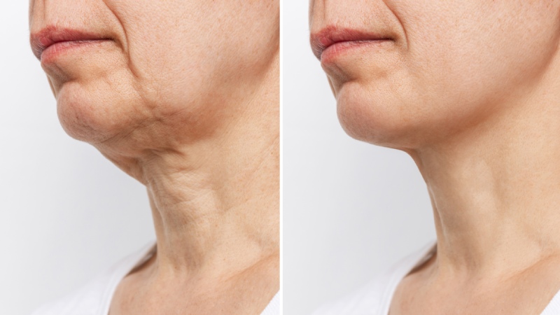 Before and after pictures of a neck lift