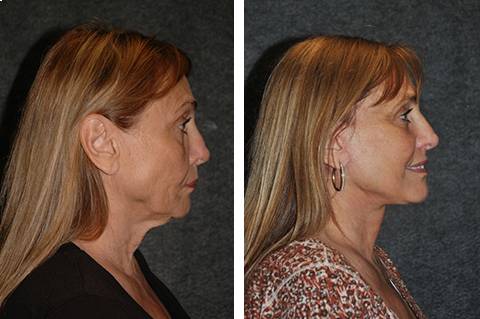 Facelift before and after patient 27 side view | Lifted cheeks, reduced jowls and youthful neckline | New York Facial Plastic Surgery