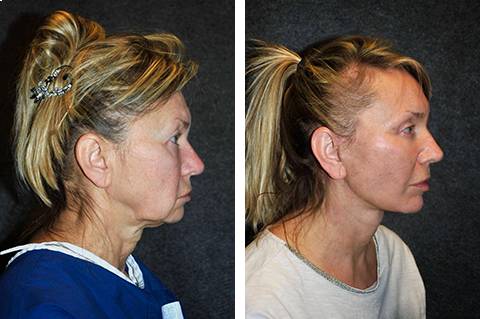 mini Facelift before and after patient 33 | Lifted cheeks, smooth jawline, brow and eye lift | New York Facial Plastic Surgery