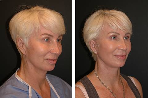 mini Facelift before and after patient and Necklift 9 | New York Facial Plastic Surgery