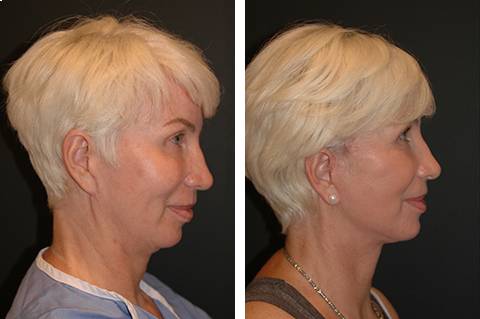 mini Facelift before and after patient and Necklift 9 side view | New York Facial Plastic Surgery