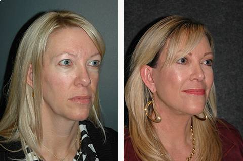 mini Facelift before and after patient 36 side view | Upper and Lower Eyelid & revision rhinoplasty | New York Facial Plastic Surgery