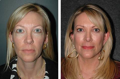 mini Facelift before and after patient 36 | Upper and Lower Eyelid & revision rhinoplasty | New York Facial Plastic Surgery