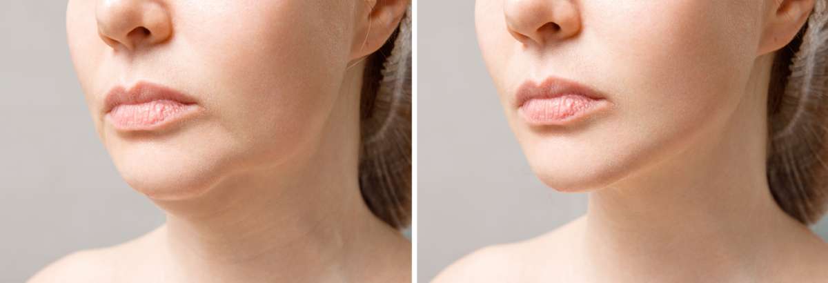 Facelift before and after pictures focusing on the chin and jaw