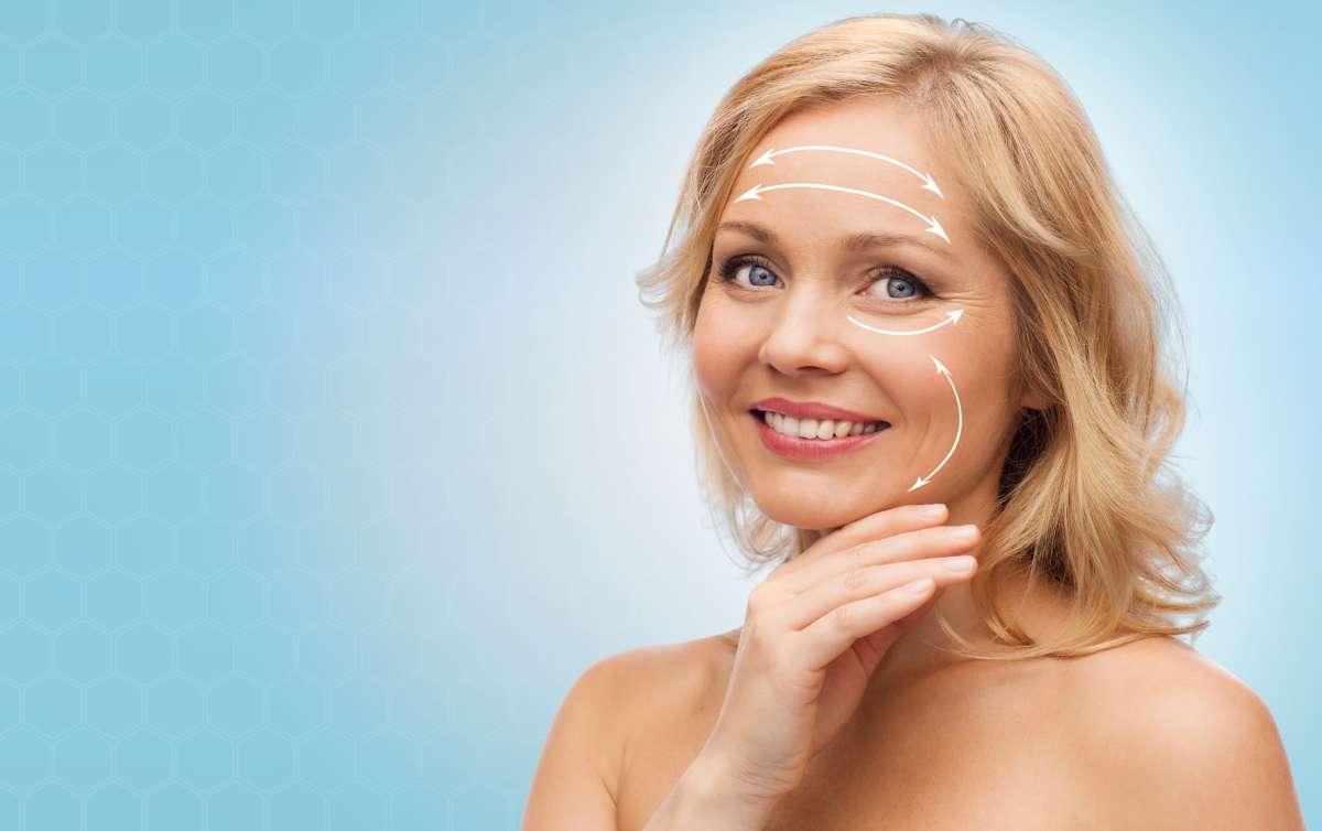 A woman smiling with lines on her face showing where she had her facelift incisions