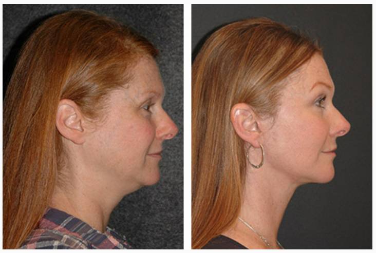 Vertical Facelift Patient Before and After Photos Side View