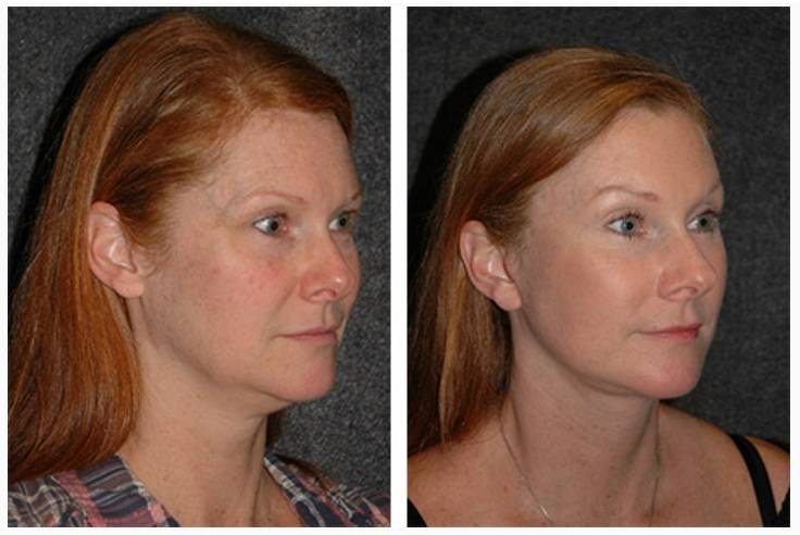 Vertical Facelift Patient Before and After Photos View