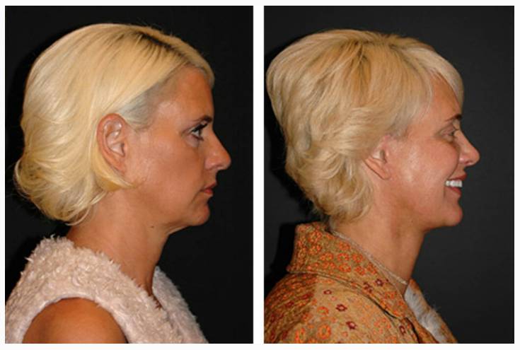 Vertical Facelift Patient Before and After Photos Front View