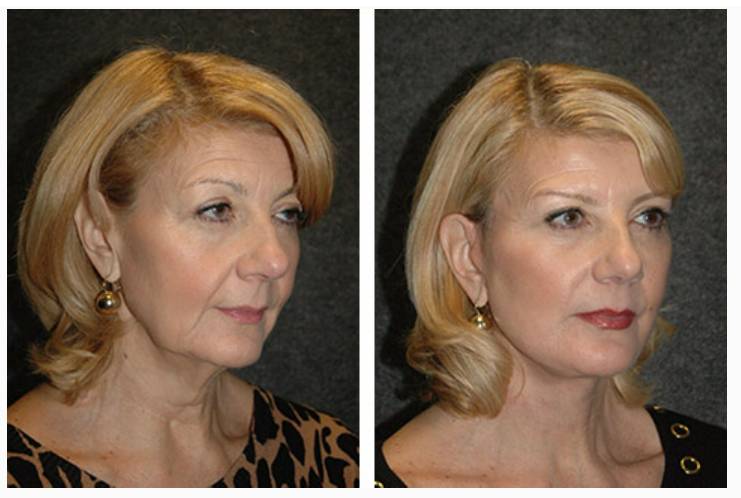 Vertical Facelift Patient Before and After Photos Front View
