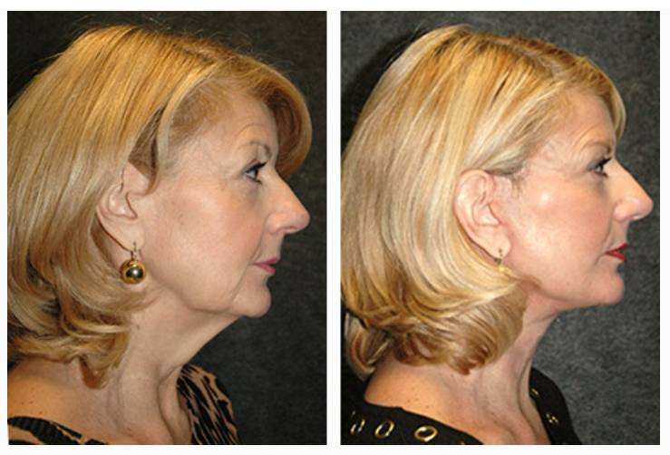 Vertical Facelift Patient Before and After Photos