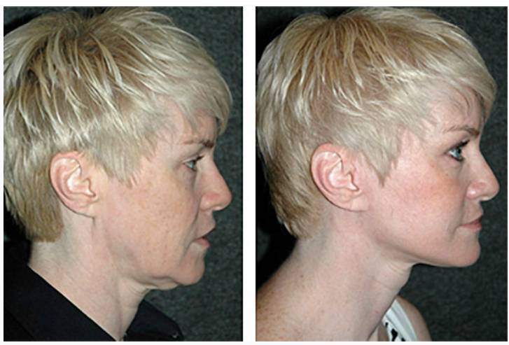 Vertical Facelift Patient Before and After Photos Front View