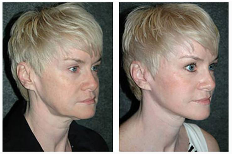 Vertical Facelift Patient Before and After Photos