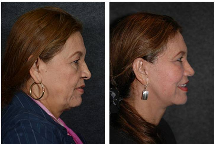 best vertical facelift before after photos