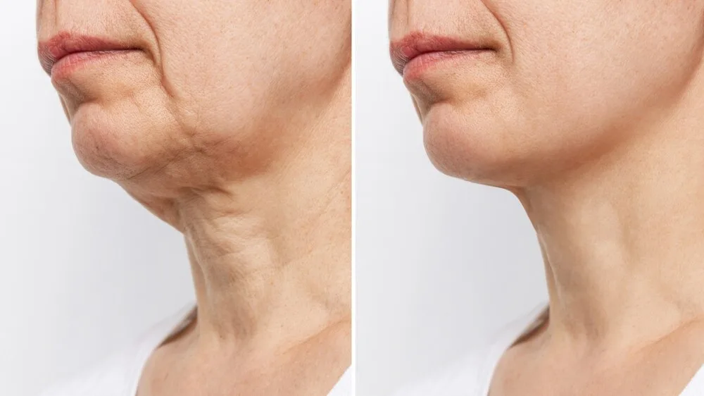 Before and after shots of a woman who has had a neck lift