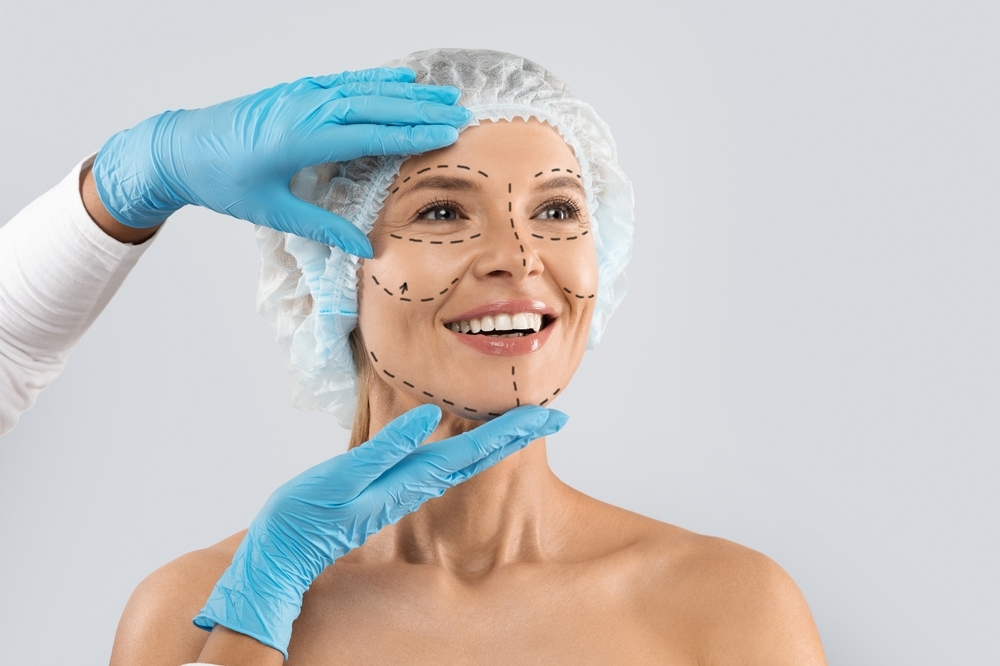 Woman Preparing for Facelift Procedure with Lines Drawn on Face - New York Facial Plastic Surgery