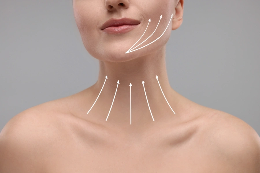 A woman with lines on her neck showing her neck lift