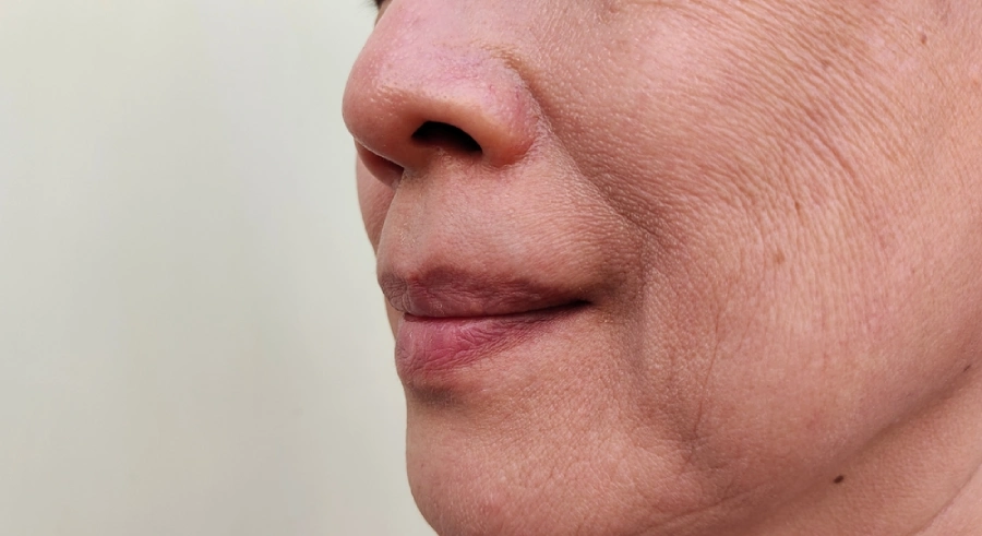 A woman with smile lines